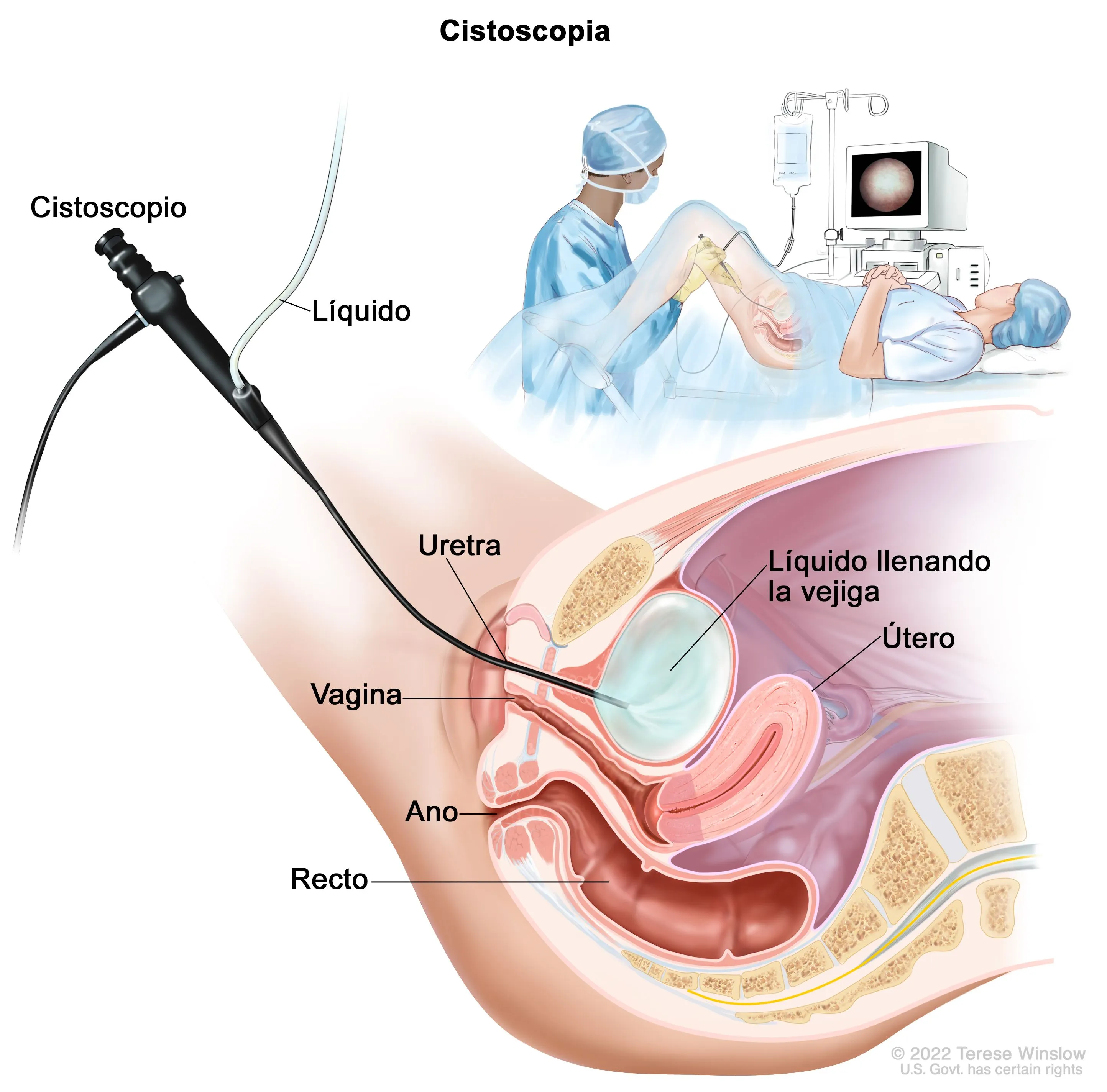 Cistoscopia (endoscopia de vejiga)