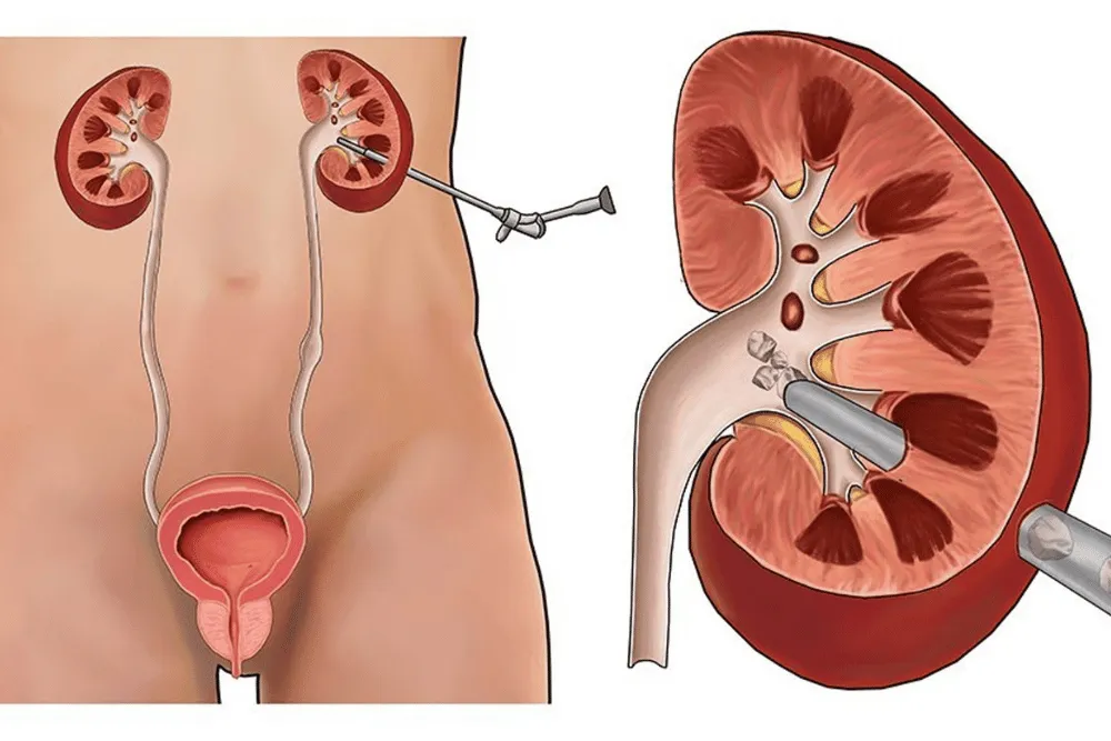 Nefrolitotomía percutánea (NLPC)