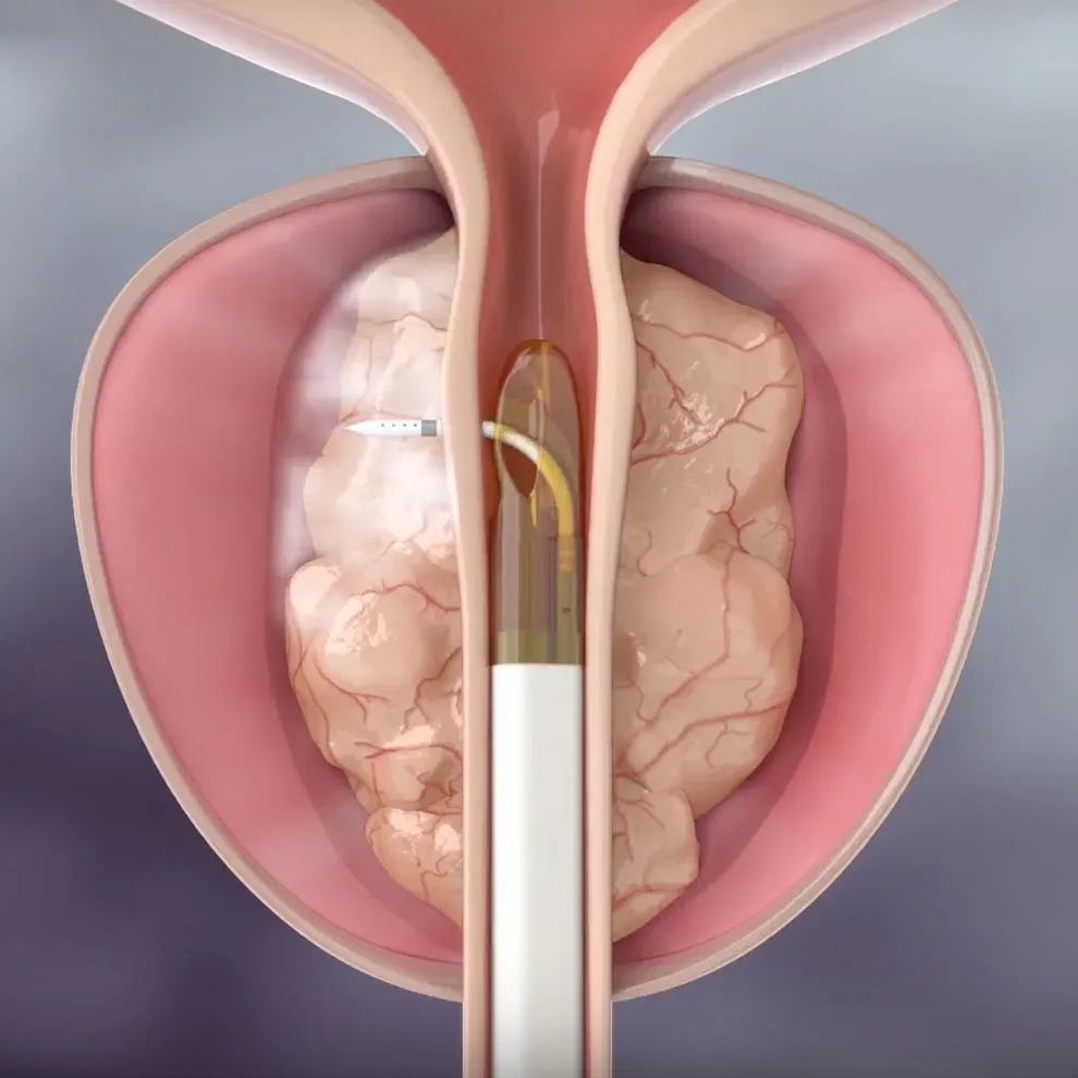 Rezum: terapia de vapor para la próstata