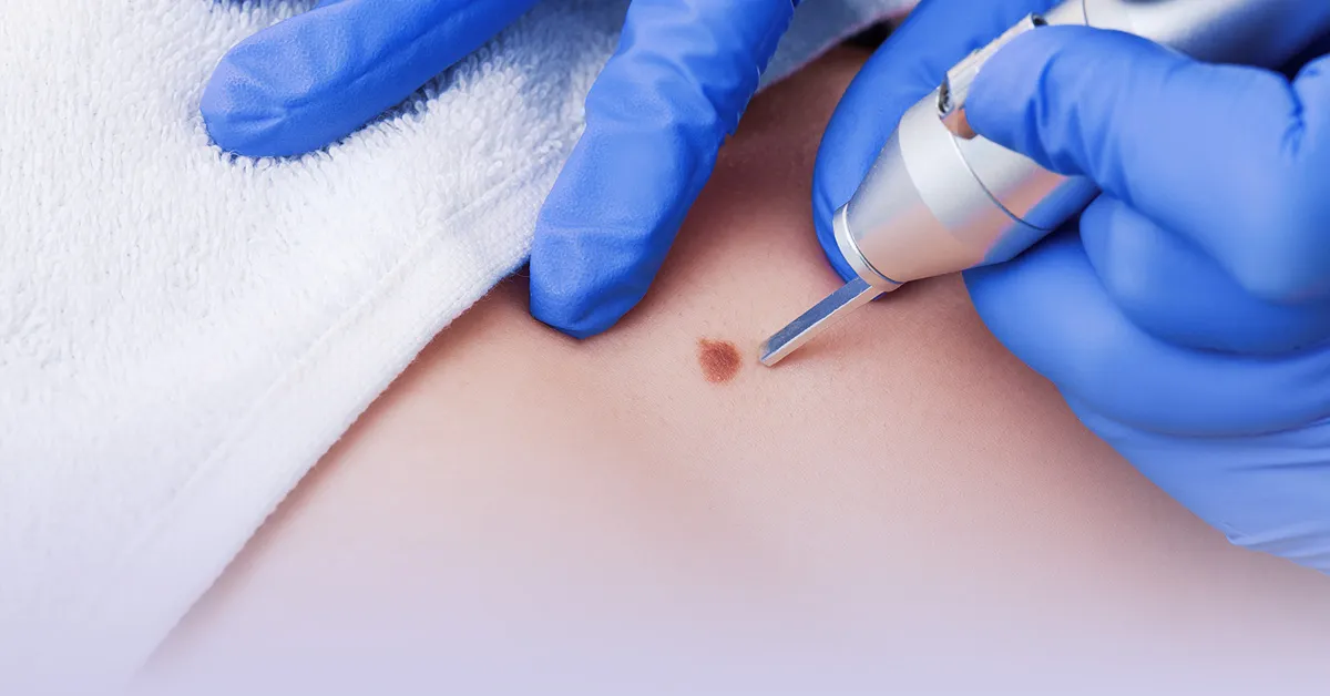 Verrugas genitales por VPH