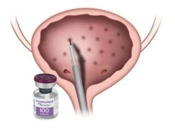 Bótox en la vejiga (toxina botulínica)