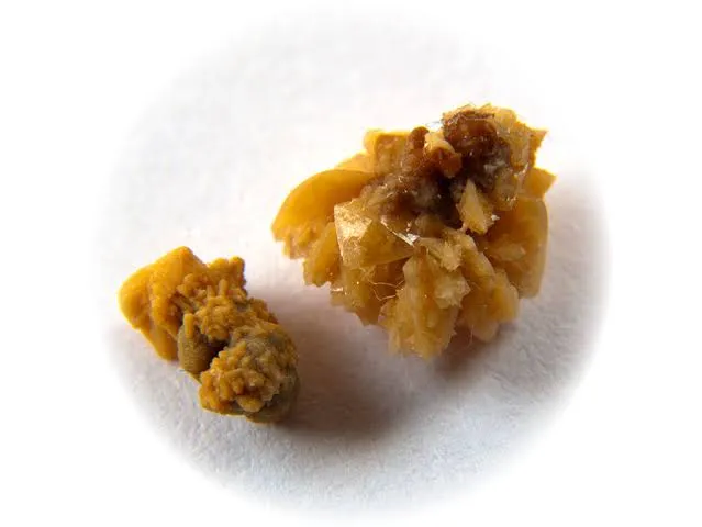 Piedras en el riñón (cálculos renales)