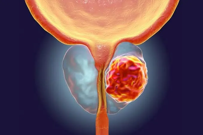 Información sobre el cáncer de próstata: síntomas, prueba de PSA y quién tiene más riesgo