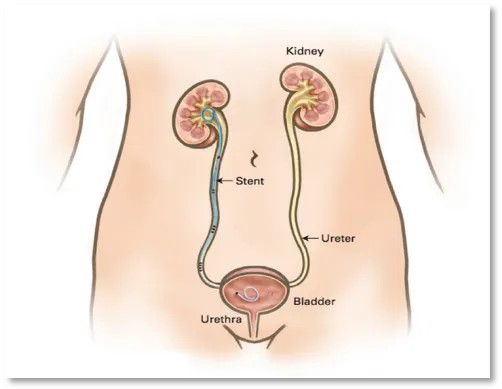 Stent ureteral o catéter doble J