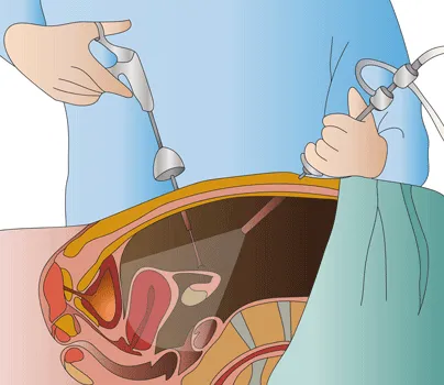 Laparoscopía urológica