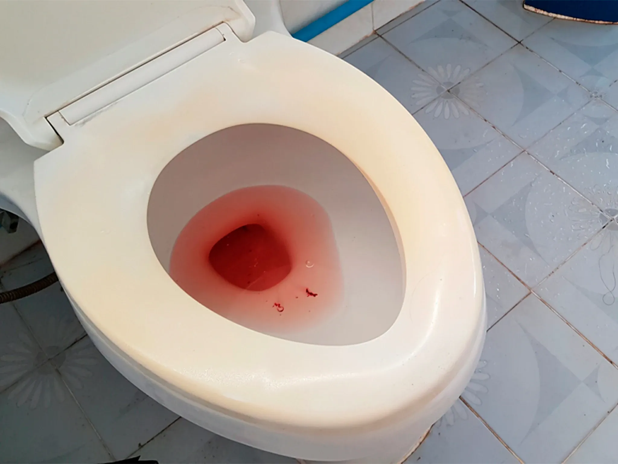 Hematuria: orina con sangre y los estudios para encontrar su causa