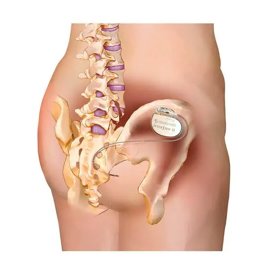 Neuromodulación sacra