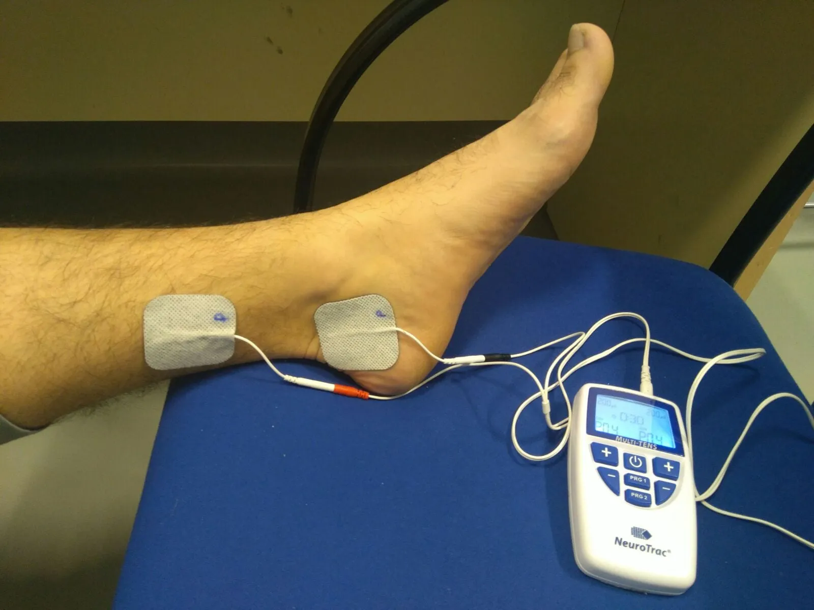 Neuromodulación del nervio tibial