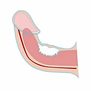 Peyronie (curvatura del pene)