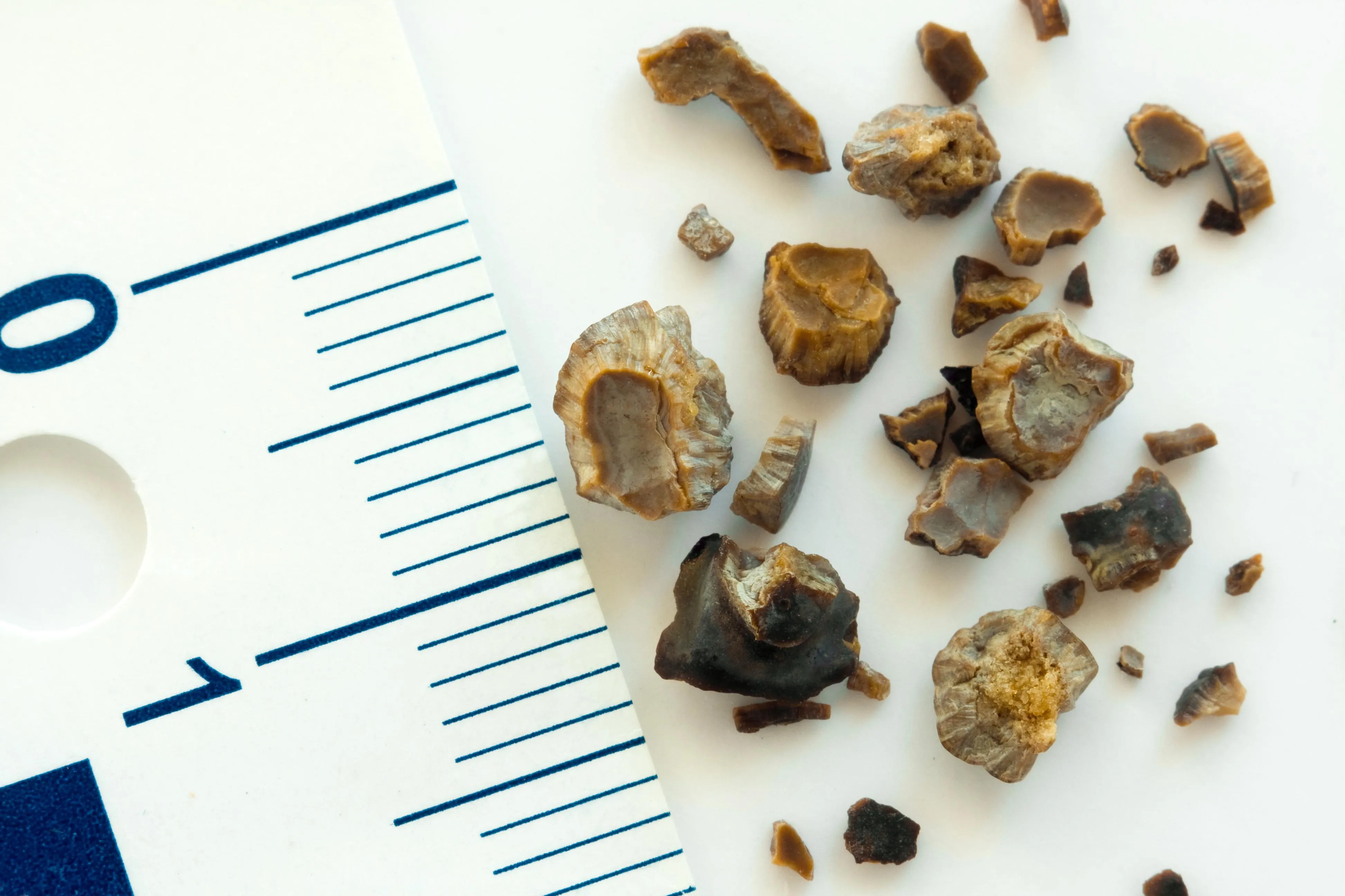 Piedras en el riñón: por qué aparecen los cálculos renales, qué síntomas dan y cómo evitarlos