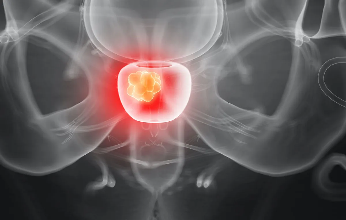 Prostatitis o inflamación de la próstata