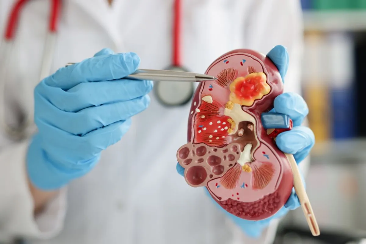 Destechamiento de quiste renal