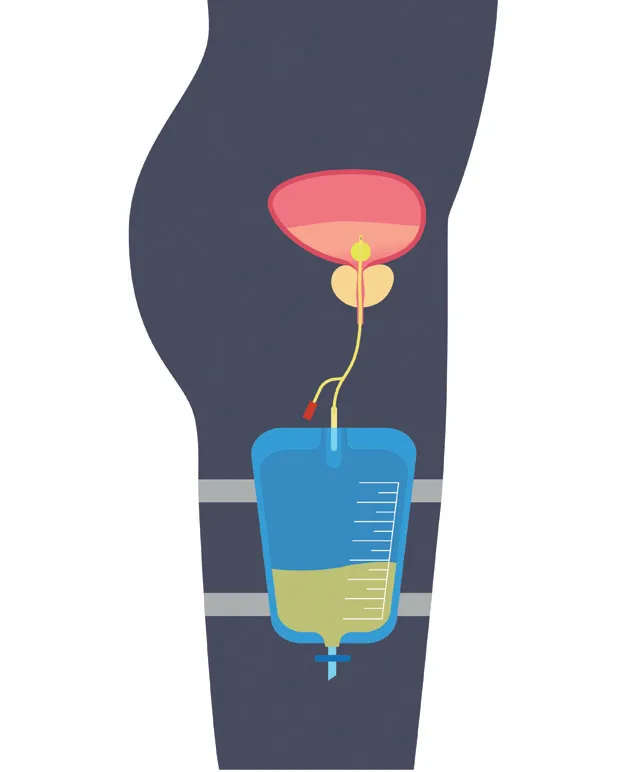 Sonda urinaria
