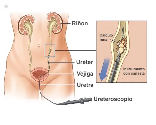 Ureteroscopía con láser