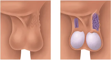 Varicocelectomía para varicocele