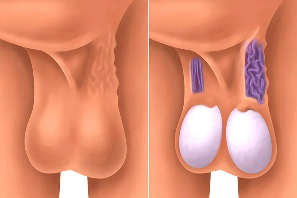 Várices en el escroto: venas testiculares dilatadas por varicocele
